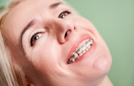 האם אפשרי לעשות יישור שיניים בגיל מבוגר?